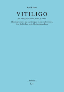 Vitiligo
