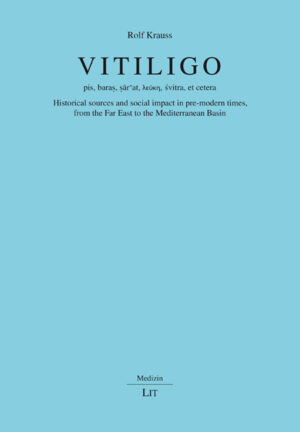 Vitiligo